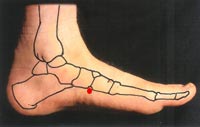 Location of KD-2 on left foot