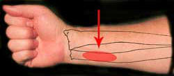 HT-4 area located on right forearm